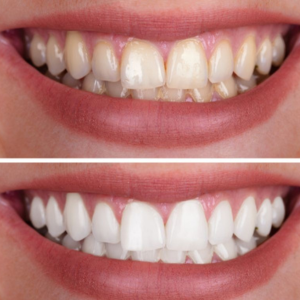 clareamento dental campinas